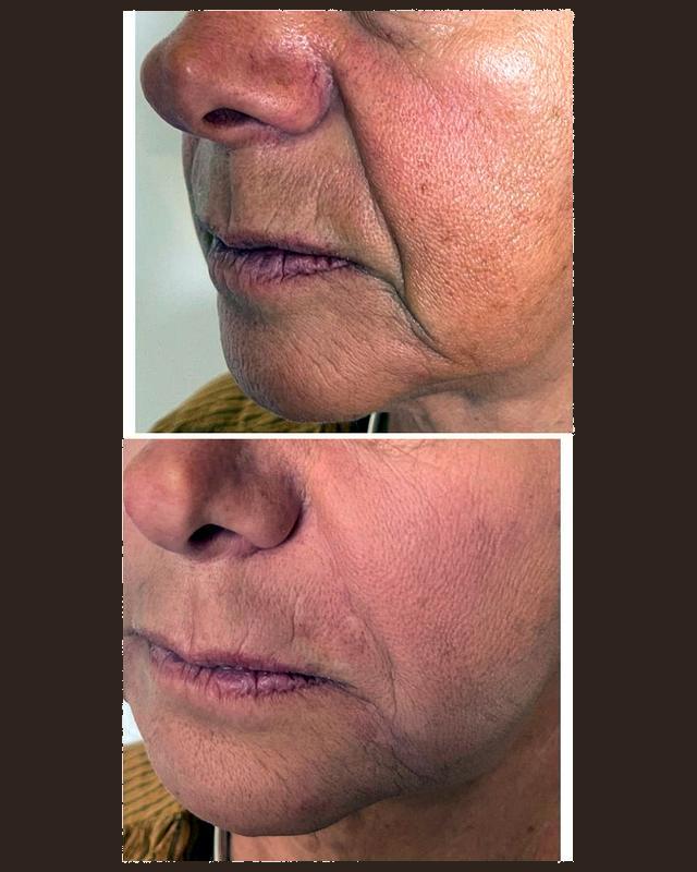 Before and after treatment result