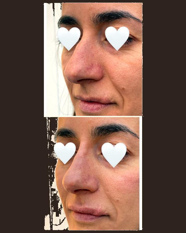 Before and after treatment result