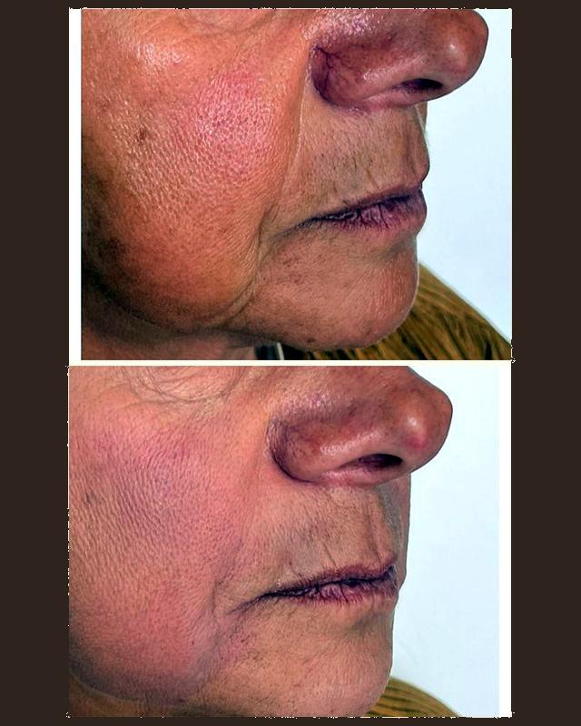 Before and after treatment result