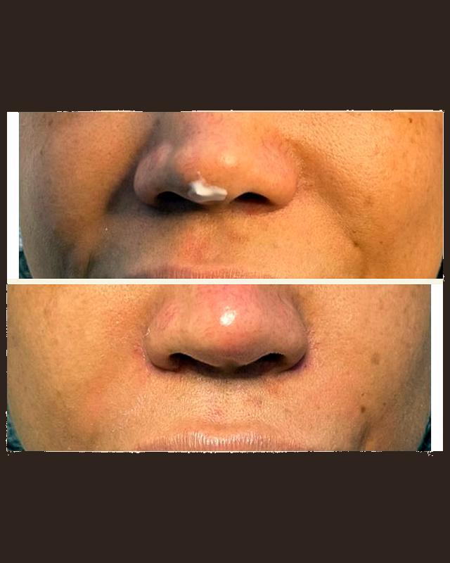 Before and after treatment result