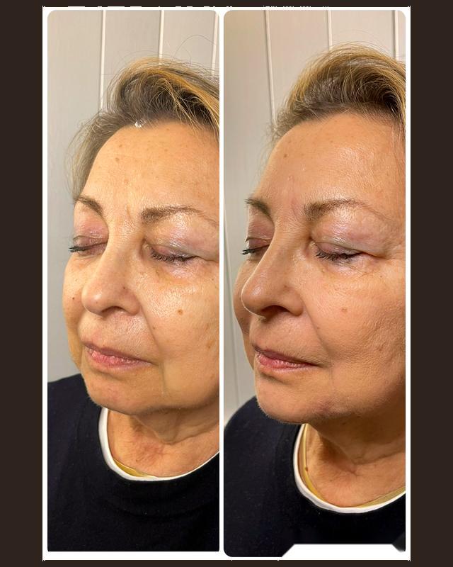 Before and after treatment result